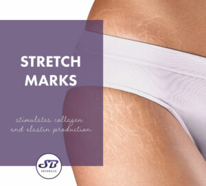 Skinbase stretch marks