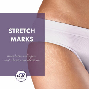 Skinbase stretch marks